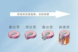 腰椎间盘突出严不严重，主要看这5个指标图片