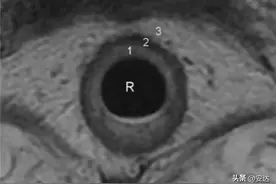 直肠癌MR分期及预后评估图片
