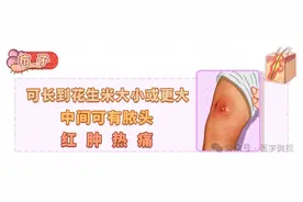 身上长了个很大的痘痘，红肿疼痛，是疖子吗？图片