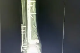 拿十万换骨折愈合，你换不换？图片