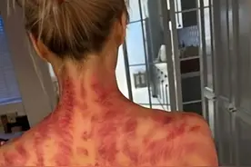 香港天后郑秀文晒刮痧照，脖子和背部呈深红色，健康状况惹人担忧图片