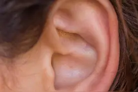 耳洞里臭臭的，耳朵爱长痘？都是因为它没做好！图片