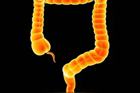 肠癌微卫星不稳定的检测及临床价值图片