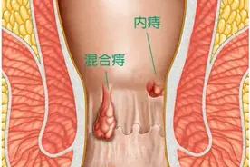 痔疮都有哪几种？图片