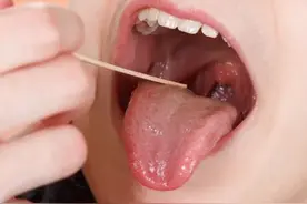 扁桃腺肿大的原因，中医分型与治疗图片