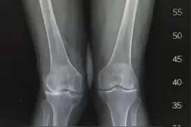 外翻膝是怎样的，造成的原因是什么？听听医生详细分析解读！图片