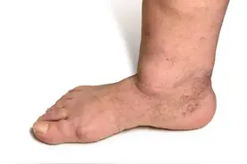 足踝肿胀和静脉曲张的关系图片