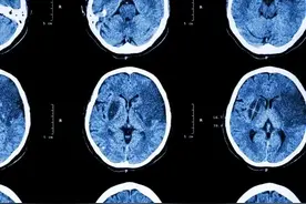 关于“脑梗塞”治疗药物，超经典总结！（建议收藏）图片