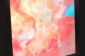 泌尿外科医生告诉您：查出血尿后必须做的检查图片