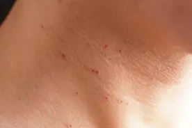 皮肤小肿物之扁平疣图片