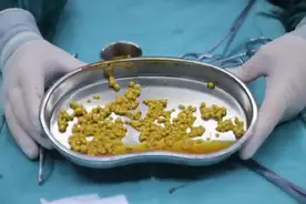 肾有没有结石，从排尿能看出来？医生提醒：一般会出现这4个现象图片