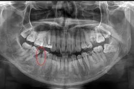 手把手教你看牙片，都是干货，建议收藏！图片