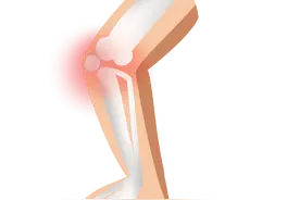 一觉醒来，腿脚僵硬，骨关节炎患者如何顺利过冬？图片