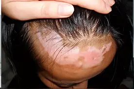 复方甘草酸苷片治白癜风？这些用药细节你真的懂吗？图片