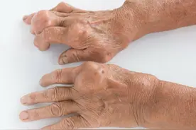 痛风石好发于哪些部位？分别有何危害？如何预防？图片