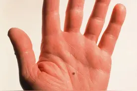 身上这三处有痣，是大富大贵之命？图片