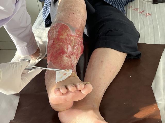 小腿破了老不好怎么办