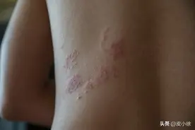 确诊带状疱疹，需要做什么检查？图片