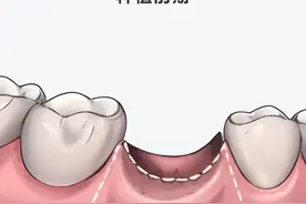 种植牙记(4)：做牙模和安装图片