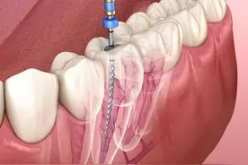 根管治疗到底是什么？一定要做吗？图片