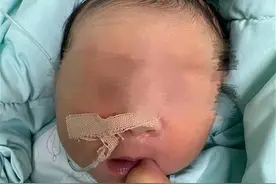 一出娘胎，宝宝嘴角“挂”了颗肉球！协和专家联手摘除图片