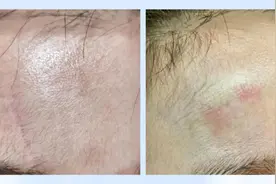 疤痕修复的最佳时间你知道吗图片