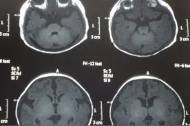 脑萎缩到底需不需要治疗？科学使用4类药物，积极改善大脑功能图片