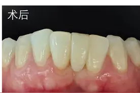 免拔牙，新技术“粘接桥”解决轻度牙列不齐图片