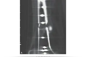 实例分享 | 通过影像学检查判断骨折愈合情况图片