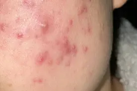 快速总结一下我用过的几款祛痘膏！自用无广！图片