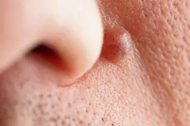 头皮上的痂是什么？为什么不能用手抠头上的痂？图片