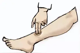 都是水肿，有啥不一样？医生直言：造成水肿的原因很多，注意区分图片