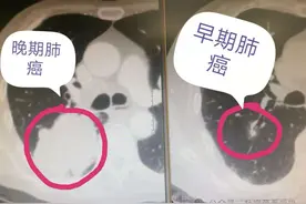 肺结节有以下6个特征，恭喜你：多半是良性的，无需手术切除！图片