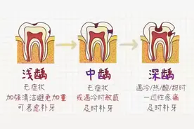 ​根管治疗是杀神经？拔牙髓？可以不做吗？图片