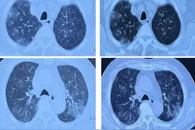 感染铜绿却精准治疗无效，不典型特征匪夷所思，如何挖细节觅真凶图片