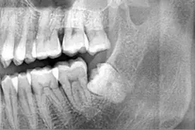 拔智齿时伤到了神经，能自愈吗？图片