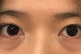 改善泪沟的方式，你适合哪一种？图片