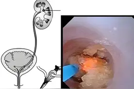 什么是输尿管软镜碎石术？有哪些优势？科普肾结石最微创手术图片