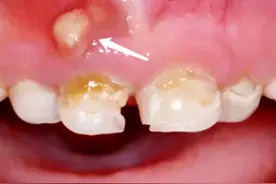 牙龈上长脓包的危害可不能小觑图片