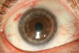 白内障术后 3 个月很关键！做好日常护理！图片