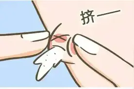 你的痘痘挤出来的是什么图片