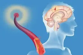 发现腔隙性脑梗死咋办？服用4类药物，或改善循环，保护大脑功能图片