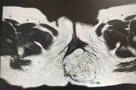 1岁宝宝屁股长出肉“尾巴”，一查竟是肿瘤图片