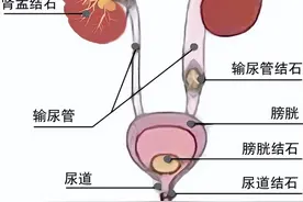 结石堵肾 膀胱 输尿管 尿道？1药堪称“碎石推土机”4类结石全铲除图片
