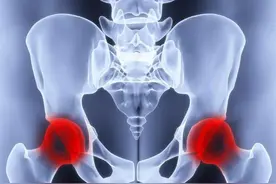 股骨头坏死疼得厉害怎么办？教你正确消除疼痛的方法图片