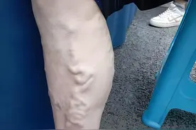 5个技巧轻松避免静脉曲张加重，久站族必看！图片