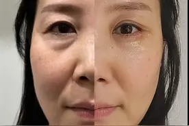 60岁去北京做中下面部提升、眼袋手术，2年后术后经历公开图片