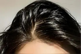 头发出油厉害，是身体的什么健康信号？医生教你两招，去油止痒！图片