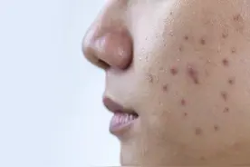 如何淡化脸上的痘印图片