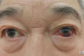 眼球出血后不要紧张，不一定与阿司匹林有关，一般不影响视力！图片